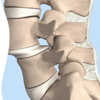 Spondylolisthesis spondylolisthesis